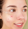 ACNÉ FACIAL