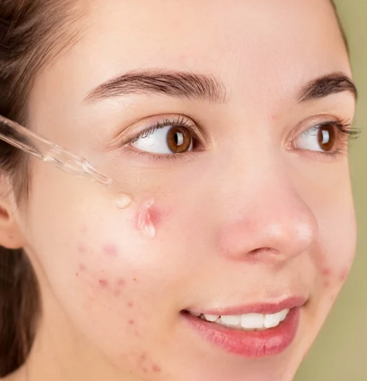 ACNE FACIAL